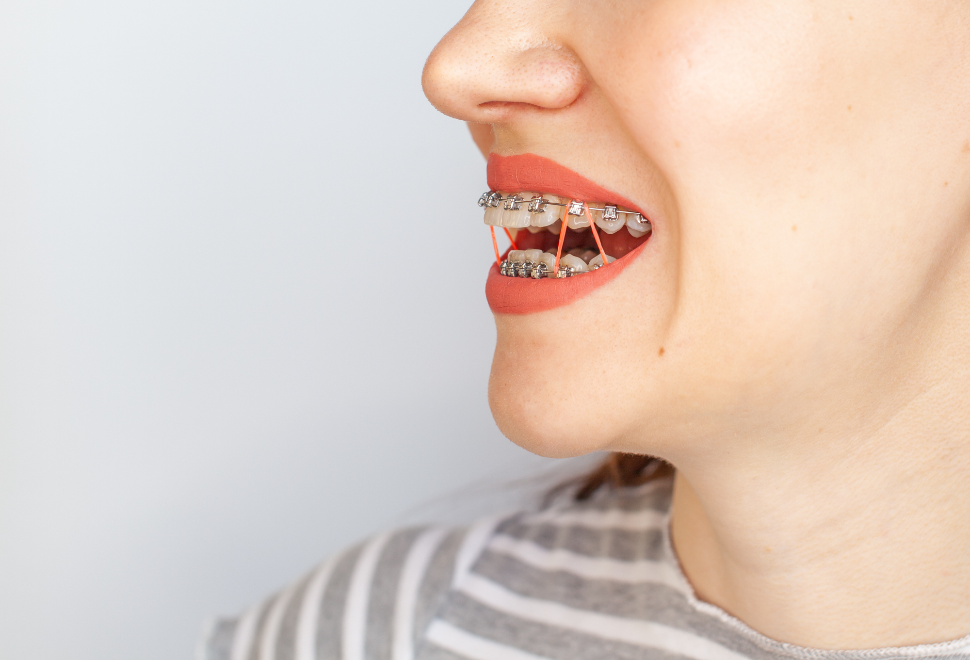 Vam je tudi izbrani ortodont predlagal nevidni zobni aparat oziroma Invisalign?